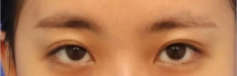 [リアル口コミ]　二重整形２週目ですよ～(^^♪